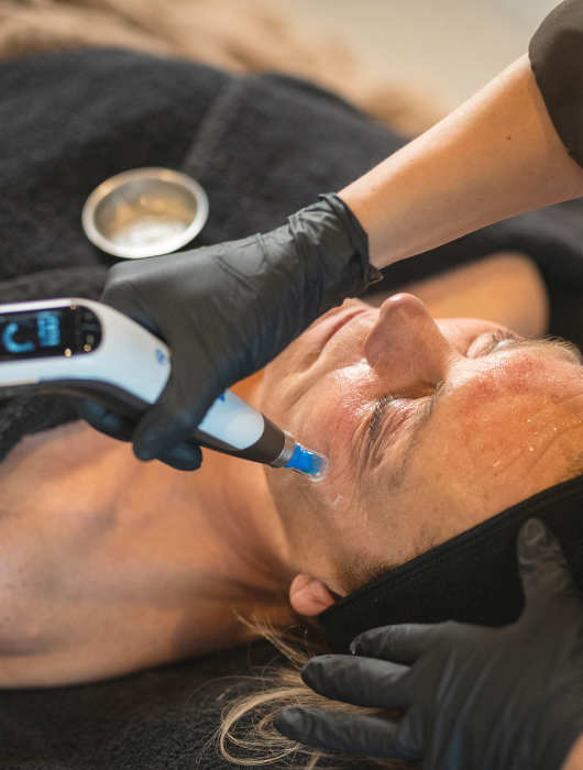 Microneedling apparaat van huidinstituut 't Achterhof, de Dermapen 4, geplaatst op het gezicht van dame.